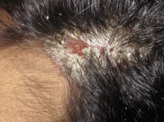El transbordo de los cabello a las entradas sobre la frente